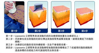 厂家直销迪姿热立塑聚焦超声刀超声波爆脂减肥机美体塑身仪器热立塑减肥仪器